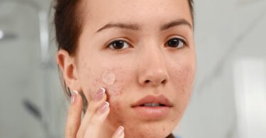 Discover the best moisturizers for acne-prone skin. Hydrate without clogging pores, reduce breakouts, and achieve a clear, glowing complexion.